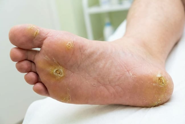 Mata Ikan di Telapak Kaki, Inilah Penyebab dan Cara Mengatasinya - Alodokter