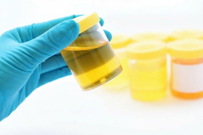 Mikroalbumin Urine, Pemeriksaan untuk Deteksi Dini Masalah Ginjal - Alodokter