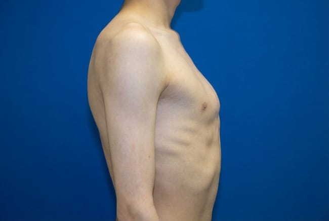 Tulang Dada Menonjol, Inilah Beberapa Informasi yang Perlu Dipahami - Alodokter