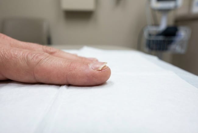 Kuku Copot, Inilah Penyebab dan Tips Pertolongan Pertamanya - Alodokter