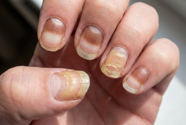 Kuku Orang Sakit Ginjal, Ketahui Tanda dan Penyebabnya - Alodokter