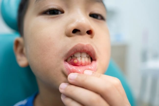 Benjolan di Gusi Anak, Inilah Informasi Selengkapnya! - Alodokter