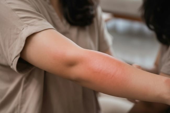 Sindrom Skeeter, Reaksi Alergi Serius Akibat Gigitan Nyamuk - Alodokter