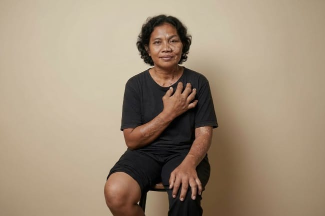 Sindrom Proteus, Kenali Gejala dan Langkah Penanganannya - Alodokter