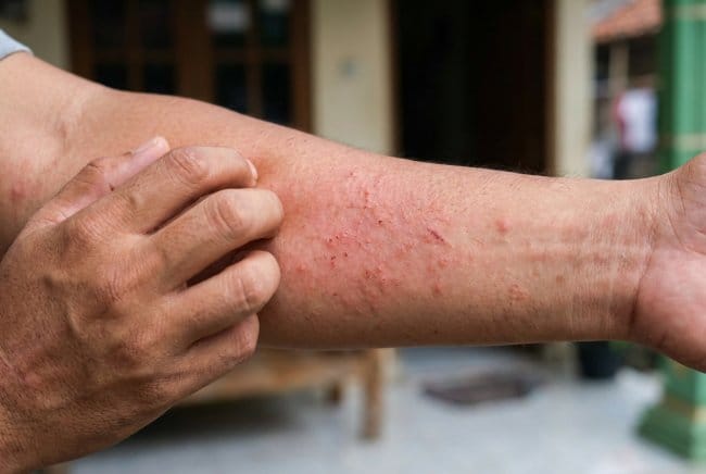 Kenali Perbedaan Gatal karena Ginjal dan Gatal Biasa - Alodokter