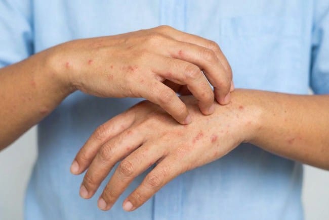 Mengenal Perbedaan Ruam Kulit Biasa dan HIV - Alodokter