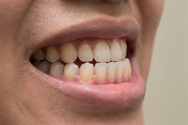 Underbite, Inilah Gejala, Penyebab, dan Cara Menanganinya - Alodokter