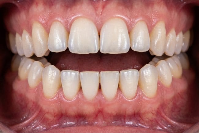 Open Bite, Inilah Gejala, Penyebab, dan Penanganannya - Alodokter