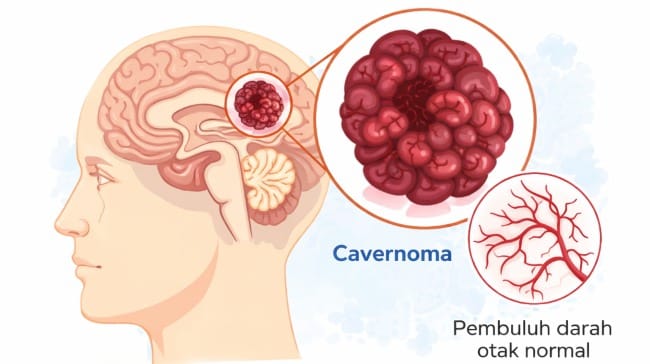 Cavernoma