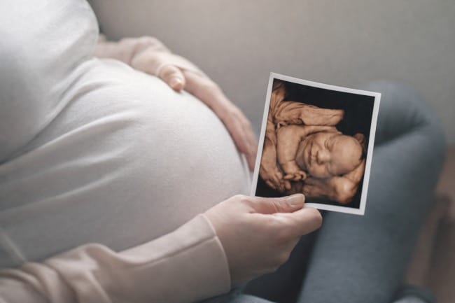 USG 5 Dimensi, Ini Keunggulan dan Pertimbangannya bagi Ibu Hamil - Alodokter