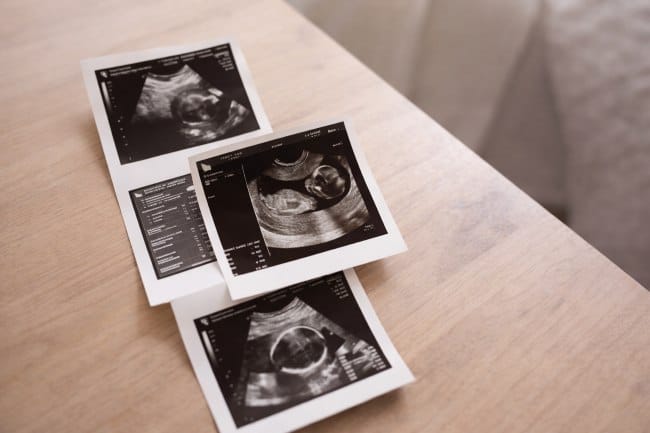 USG 2 Dimensi pada Kehamilan untuk Memantau Pertumbuhan Janin - Alodokter