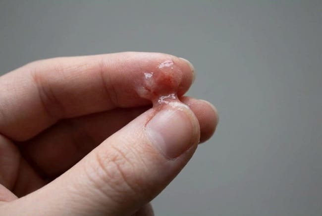 Keputihan Bercampur Darah, Kenali Penyebab dan Cara Mengatasinya - Alodokter