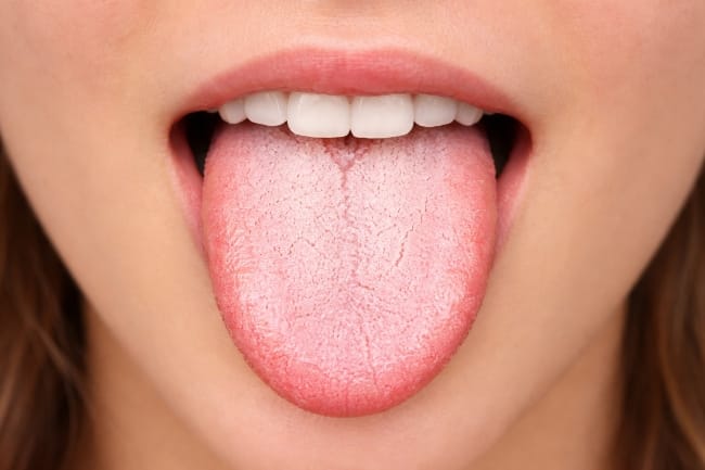 Lidah Putih dan Pahit, Inilah Berbagai Informasi yang Perlu Dipahami - Alodokter