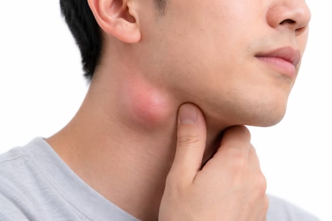 Tumor Kelenjar Getah Bening