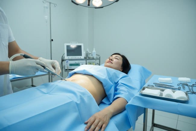 LAMS, Inovasi Pengurangan Lemak yang Minim Nyeri - Alodokter