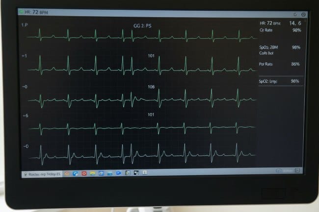 Sinus Rhythm, Tanda Irama Jantung Normal yang Perlu Dipahami - Alodokter