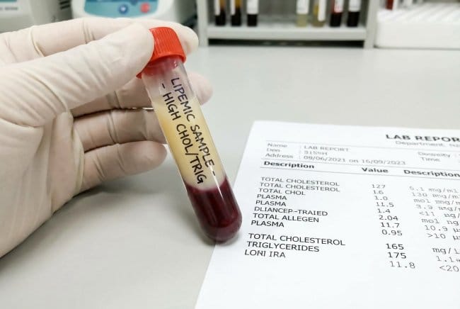 Lemak Darah, Komponen Kunci untuk Kesehatan Jantung - Alodokter