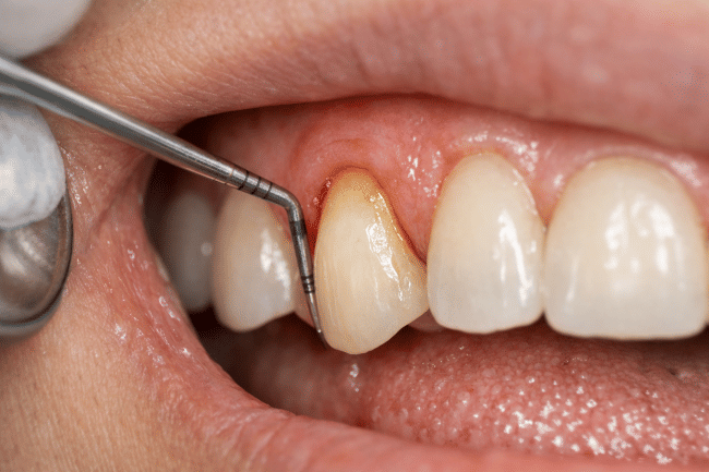 Pocket Periodontal, Kenali Gejala, Penyebab, dan Penanganannya - Alodokter