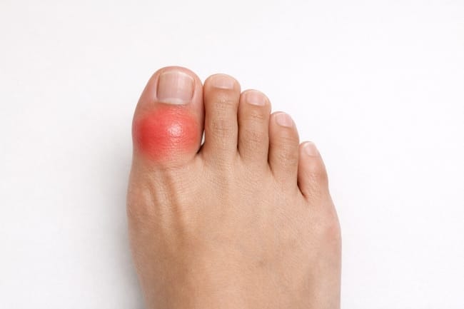 Jempol Kaki Sakit: Kenali Penyebab, Solusi, dan Tips Pencegahan - Alodokter