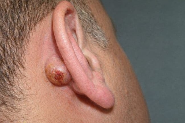 Kista di Daun Telinga, Ketahui Penyebab, Gejala, dan Cara Mengatasinya - Alodokter