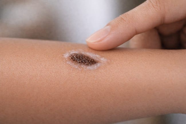 Petroleum Jelly untuk Koreng, Begini Cara Pakainya - Alodokter