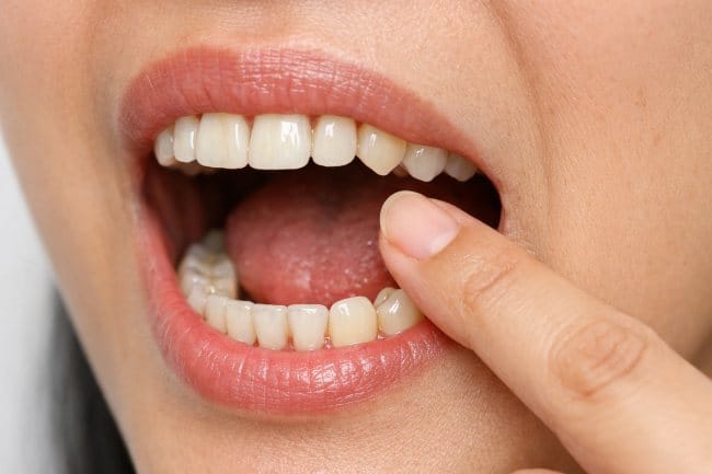 Apakah Gigi Geraham Bisa Tumbuh Lagi? Ini Penjelasannya - Alodokter