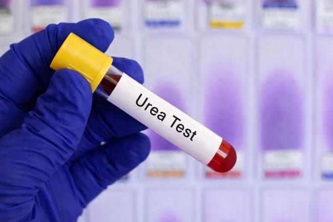 Ureum Rendah, Berikut Penyebab dan Penanganannya - Alodokter