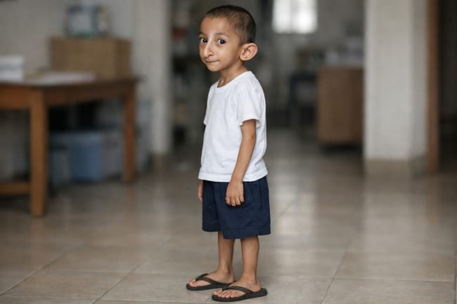 Seckel Syndrome, Kenali Penyebab, Ciri, dan Penanganannya - Alodokter