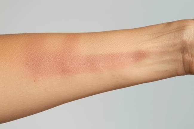 Hiperemia, Kenali Penyebab dan Gejalanya di Sini - Alodokter