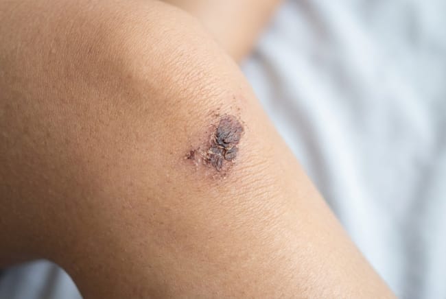 Seputar Koreng, Kenali Penyebab dan Cara Merawatnya - Alodokter