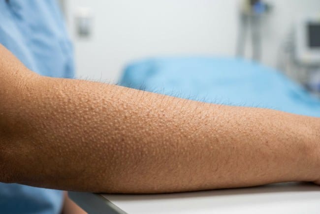 Merinding, Ketahui Penyebab dan Cara Mengatasinya - Alodokter