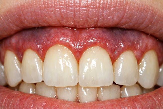 Kenali Warna Gusi yang Tidak Sehat dan Berbagai Penyebabnya - Alodokter