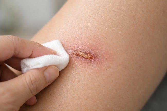 6 Tanda Luka Bernanah Mau Sembuh - Alodokter
