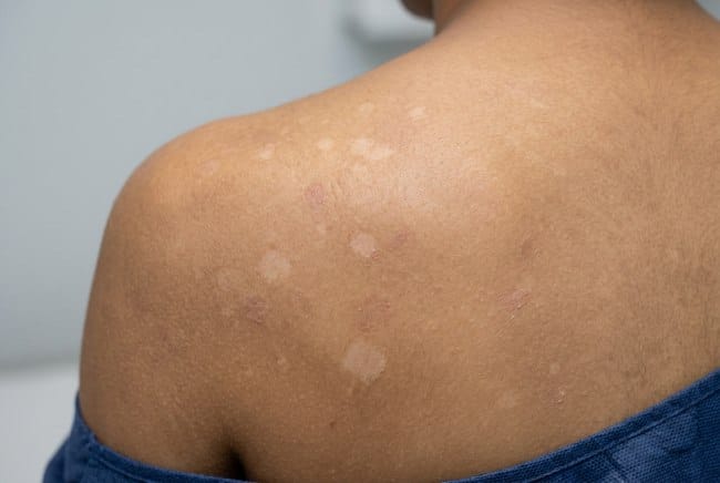 Jenis-Jenis Panu, Kenali Ciri dan Cara Pencegahannya - Alodokter