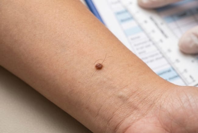 Tahi Lalat Tumbuh Rambut, Ini yang Normal dan Tidak - Alodokter