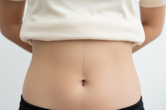 Garis Perut pada Remaja Perempuan, Ini Fakta Penting yang Perlu Diketahui - Alodokter