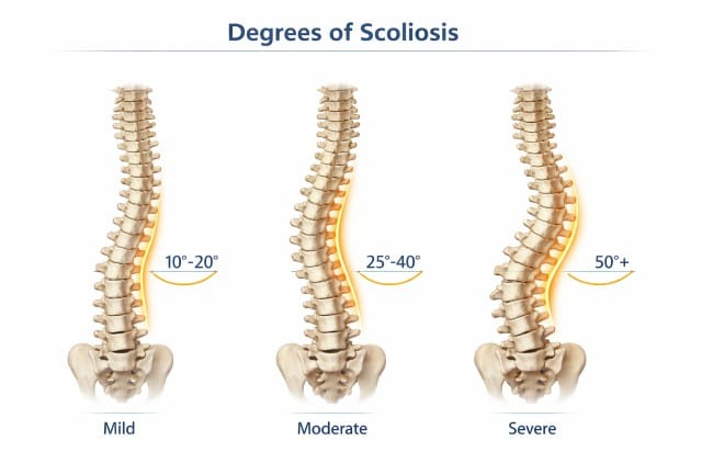 Derajat Skoliosis, Kenali Jenis dan Pilihan Penanganannya - Alodokter