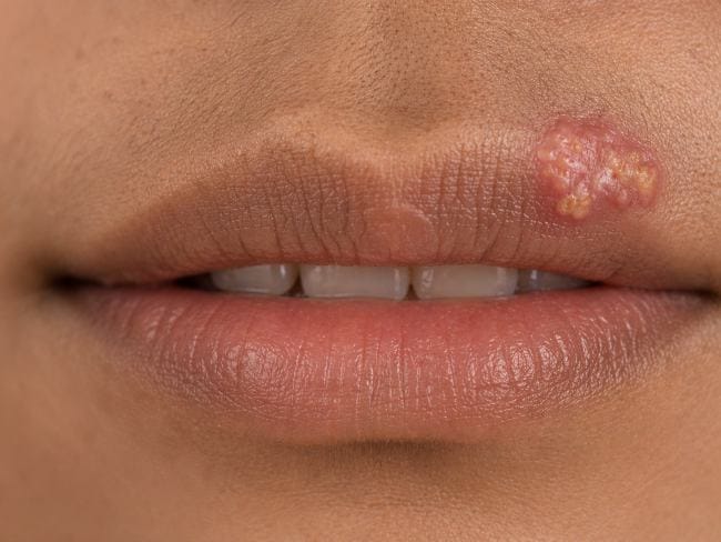 6 Pantangan Herpes agar Cepat Sembuh dan Tidak Muncul Kembali - Alodokter