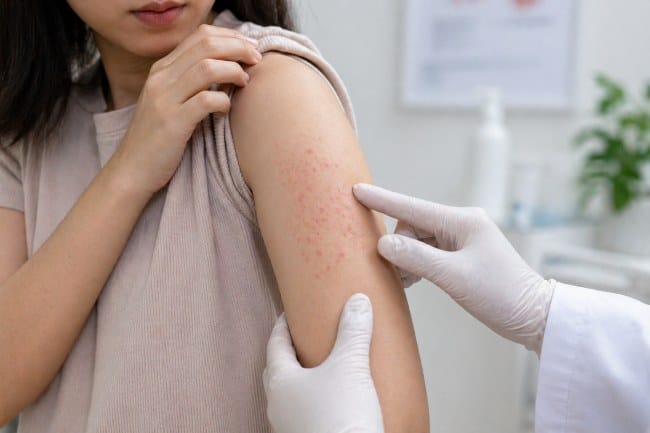5 Penyakit Kulit karena Virus yang Perlu Diwaspadai - Alodokter
