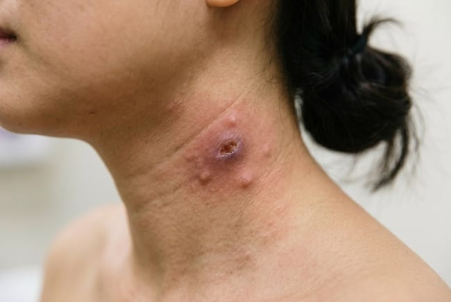 Tuberkulosis Kulit, Kenali Penyebab dan Penanganannya - Alodokter