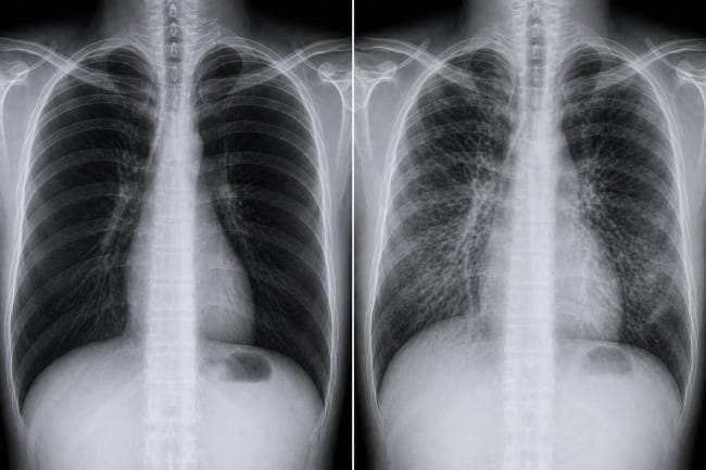 Hasil Rontgen Paru-Paru Sehat dan Tidak Sehat, Ini yang Perlu Diketahui - Alodokter