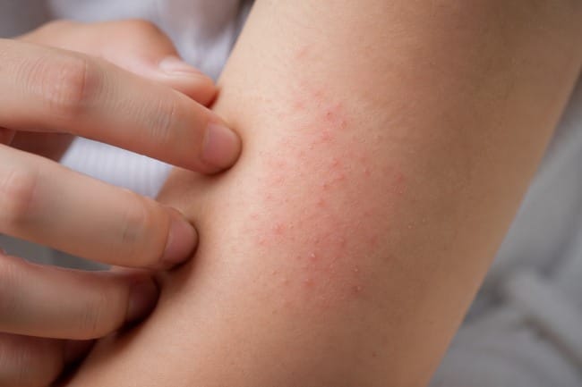 Bintik Merah Alergi, Kenali Gejala, Penyebab, dan Cara Mengatasinya - Alodokter