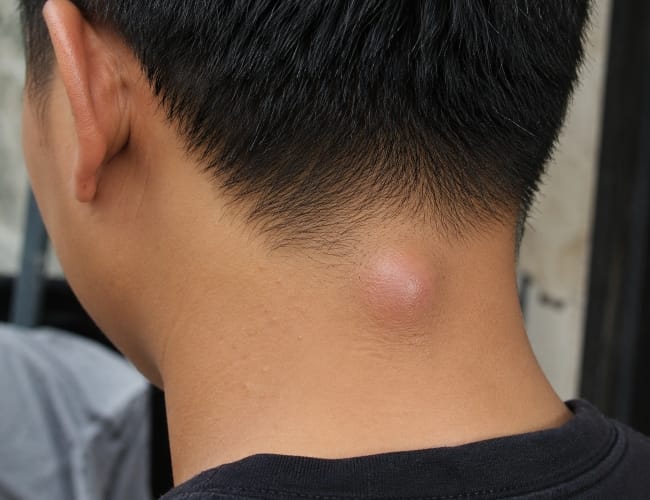 Kista Ateroma, Kenali Penyebab dan Cara Menanganinya - Alodokter