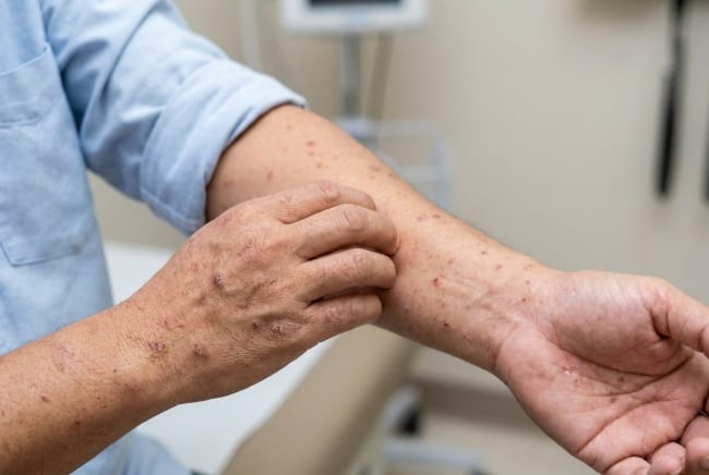 10 Ciri-Ciri Penyakit Sipilis Parah yang Perlu Diwaspadai - Alodokter