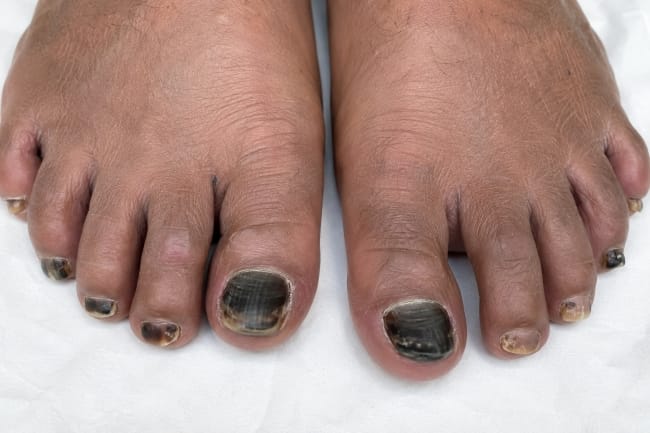 Kuku Kaki Hitam, Inilah Penyebab dan Penanganannya - Alodokter