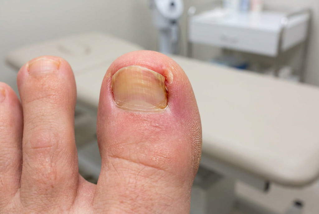 Ingrown Toenail