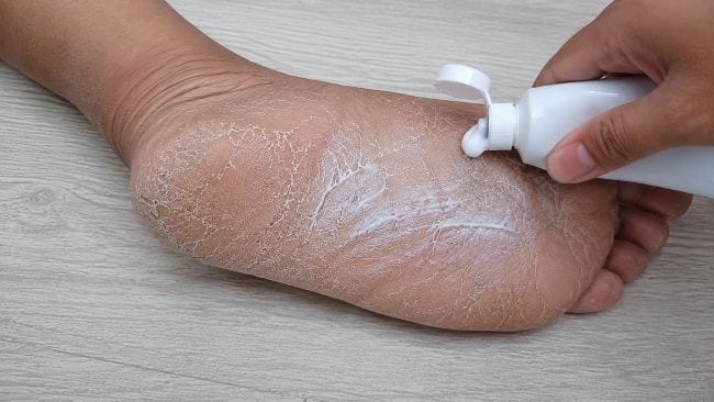 Cara Menghilangkan Kaki Pecah-Pecah dengan Odol yang Perlu Diketahui - Alodokter