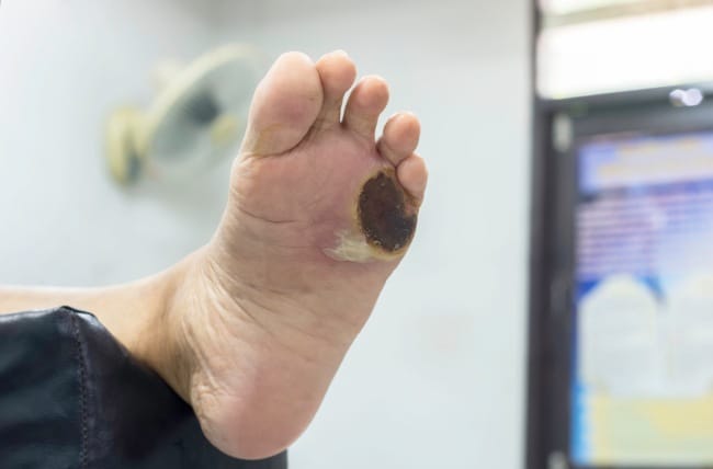 5 Cara Menghilangkan Bekas Luka di Kaki yang Sudah Lama dan Menghitam - Alodokter
