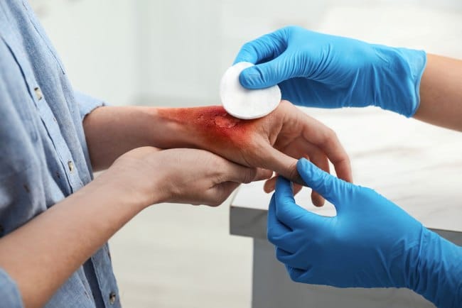 Rumah Sakit Terbaik untuk Perawatan Luka Bakar - Alodokter