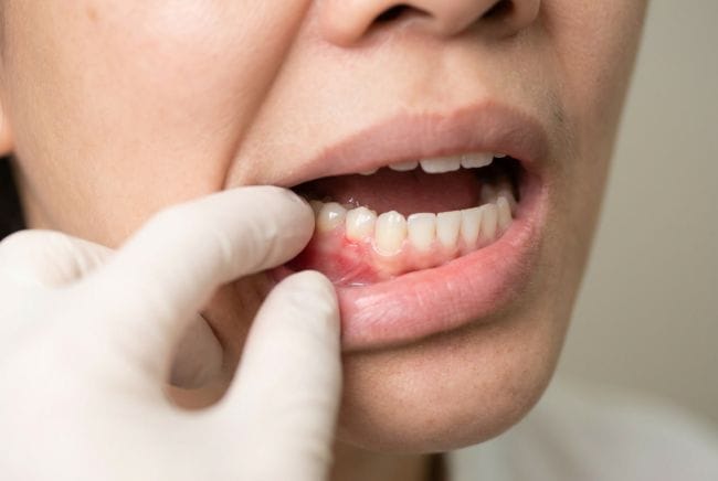 Radang Mulut, Kenali Penyebab dan Cara Mengatasinya - Alodokter